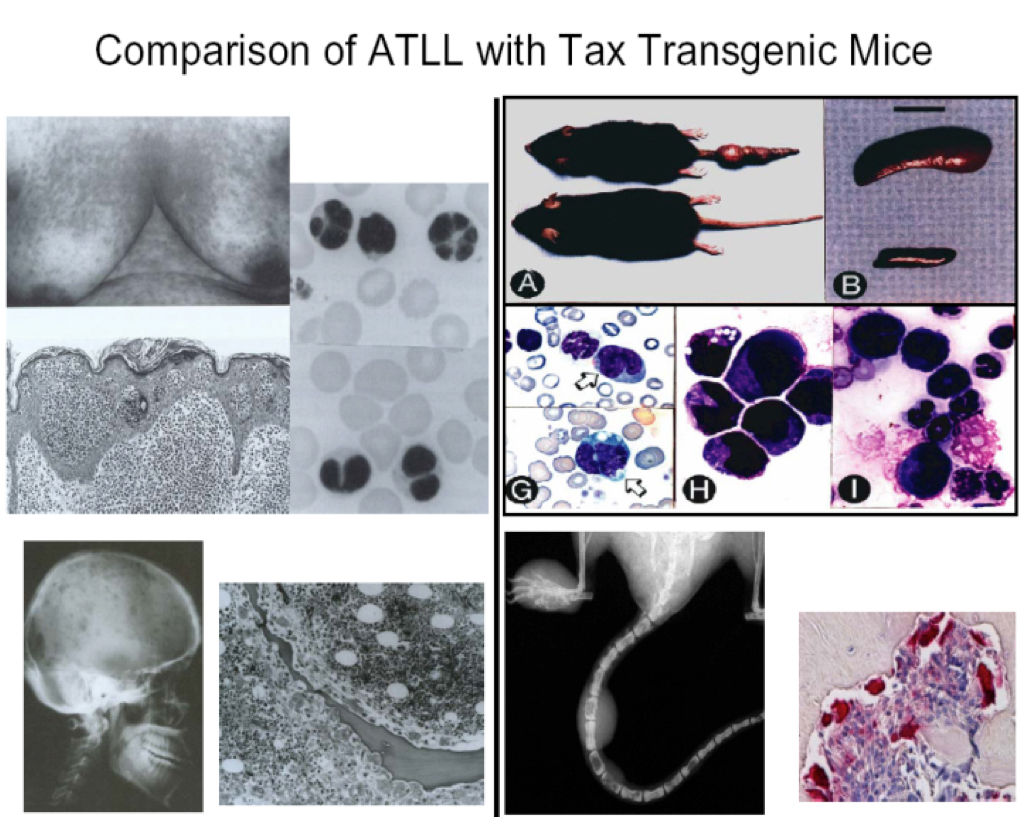 Comparison of ATLL with Tax Transgenic Mice